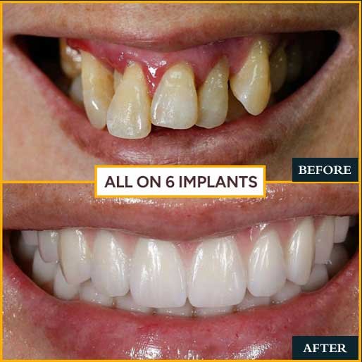 Crown & Veneer Transformation