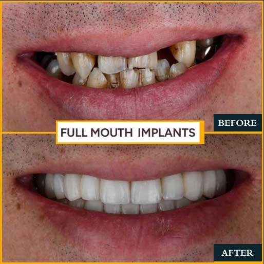 Orthodontic Smile Design