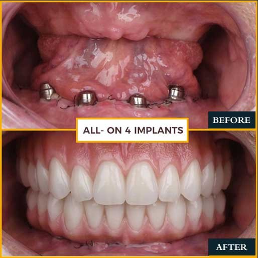 Full Mouth Rehabilitation Case