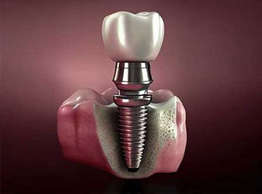 Dental Implants