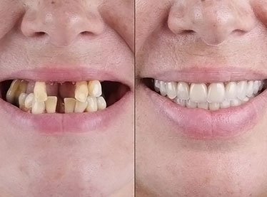 Full Mouth Rehabilitation