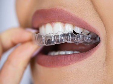Invisible Aligners