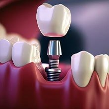 Implants Completed