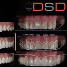 Invisalign Cases Completed